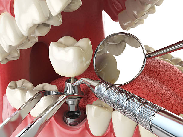 Urgent Tooth Repair in LA
